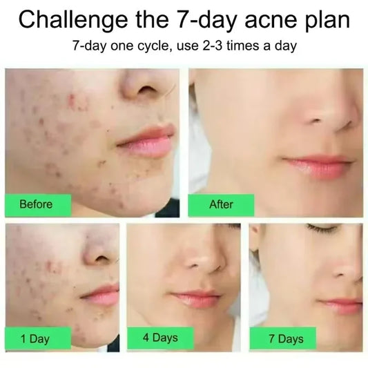Salicylic Acid Acne Treatment Face Cream