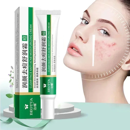 Herbal Acne Treatment Cream – Scar & Blackhead Remover